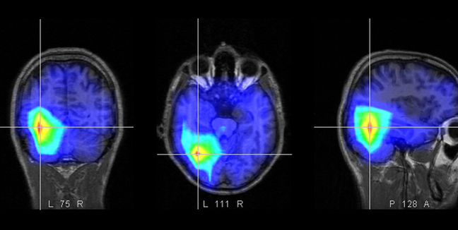 imagen del escáner de un cerebro de un paciente en estado vegetativo