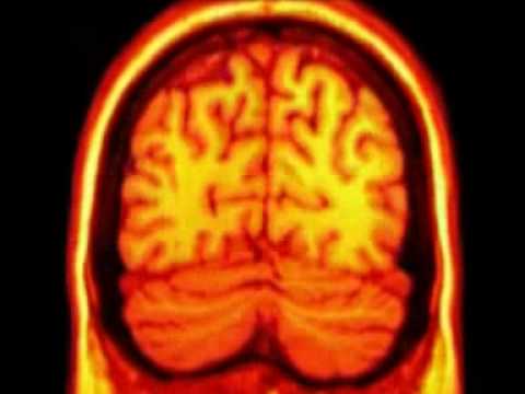 Accidente cerebro vascular: qué es y qué lo provoca