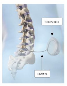 Imagen explicativa de la colocación de la bomba de blacofeno intratecal