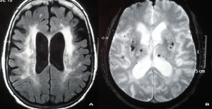 lesiones de pequeño vaso