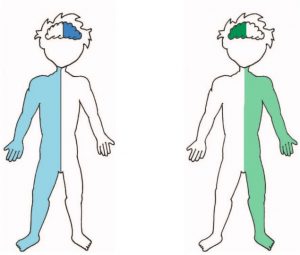 principales déficits que aparecen cuando acontece un ictus en el hemisferio cerebral derecho o izquierdo