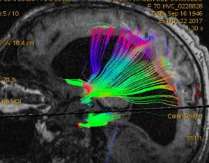 El Instituto de Rehabilitación Neurológica de Vithas vithas pone en marcha la Unidad de Estados Alterados de la Conciencia. Primera de estas características en España
