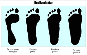 Entendemos por "pie plano" el que tiene una disminución de la altura del arco longitudinal plantar, también llamado bóveda planta