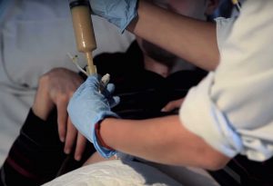 Recomendaciones de limpieza y cuidados que debes tener en cuenta con tu sonda gástrica, sonda PEG