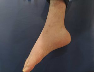 Pie equino, secuela de daño cerebral adquirido